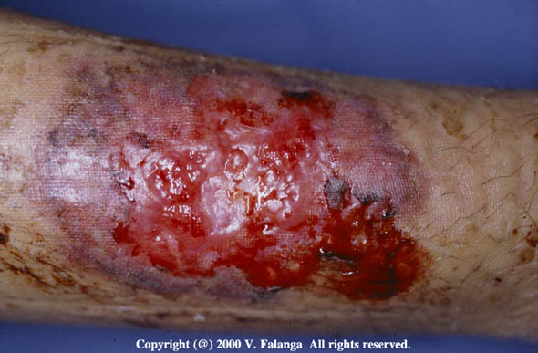 11d. Pyoderma gangrenosum in a young woman